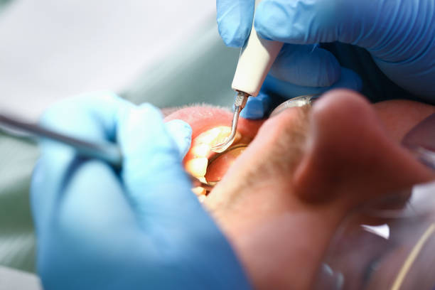 Best Dentist for Tooth Abscess  in Ellijay, GA