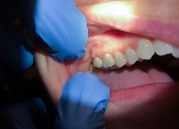 Best Broken Tooth Emergency  in Ellijay, GA